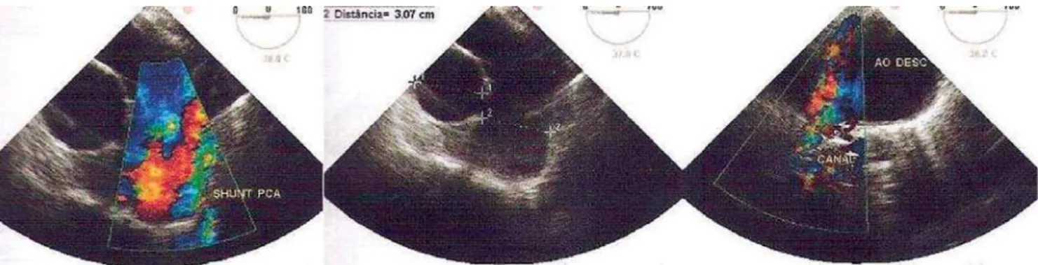 Fig. 1 – Preoperative transesophagic echocardiography showing the PDA with a directional aorto-pulmonary shunt
