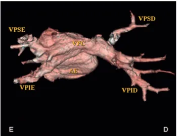 Fig. 3 - Patient EBA. Three-dimensional reconstruction with volume rendering under posterior view, showing LA and PV and appearance of totally normal anatomy