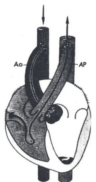 Fig. 1 - Heterotopic implantation without pre-or afterload
