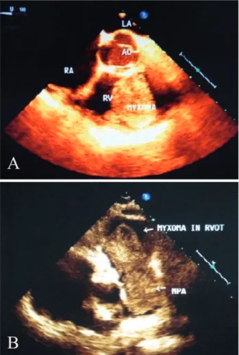 Fig. 1 – Transesophageal echocardiogram showing: A – right ventricular myxoma with its attachment to the septum; B – right ventricular myxoma prolapsing into the main pulmonary artery causing right ventricular outflow tract obstruction