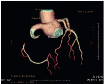 Fig. 1 - Coronary Computed Tomography Angiogram, showing the right coronary artery aneurysm formation obstructed in its proximal third, with no wall plaque