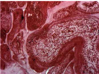 Fig. 2 – Endothelium-coated tumor rich in extracellular matrix, collagen and elastin, both muscle cells and elastic fibers (orcein 10x magnification)