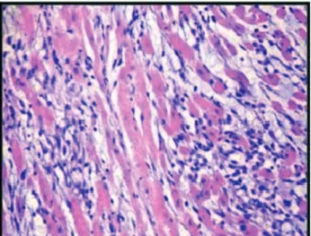 Fig. 3 -  Histopathological study showing myocardial tissue with moderate histological changes (Grade 2)