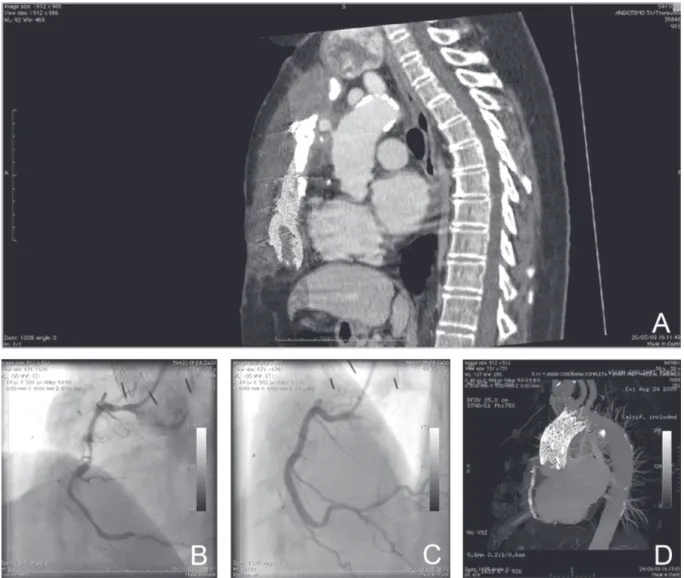 Fig. 1 – A: Pseudoaneurysm of ascending aorta. B: RCA lesions. C: Three stents implanted in RCA