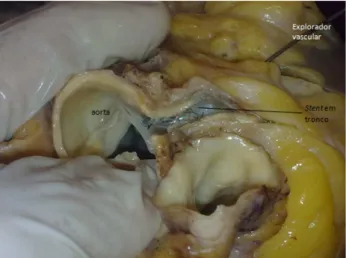 Fig. 3 - During necropsy the circumflex artery was sectioned at the proximal third, where it was introduced a vascular explorer toward the left coronary artery trunk