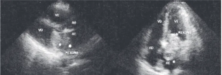 Fig. 2 - Postoperative echocardiography with no evidence of tumor masses in the left atrium