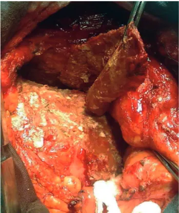 Fig. 2 - Median sternotomy, showing the pericardial cyst open with its contents being aspirated