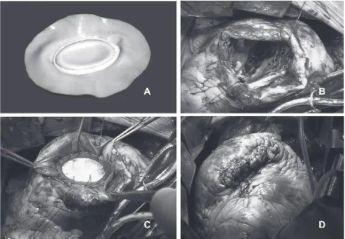 Fig. 1 - (A) The prosthesis assembled with bovine pericardium and a radiopaque ellipsoid ring