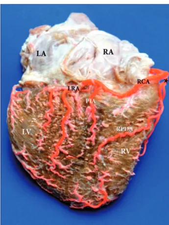 Fig. 5 - Posterior view and acute margin of the heart. Right marginal artery (*). RDPA: Right posterior diagonal artery