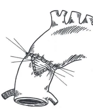 Fig. 3 – Postoperative echocardiogramBENFATTI, RA ET AL - Postpartum patient with thrombosis of
