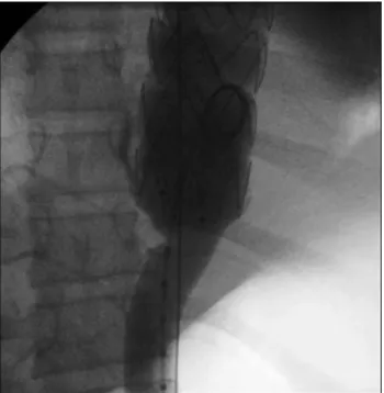 Fig. 1 - Computed tomography scan showing a  ruptured aneurysm in the descending thora cic a orta