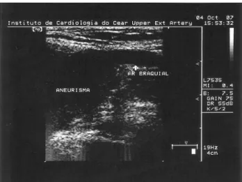 Fig. 1 - Ultrasound showing the relationship of the aneurysm with the right brachial artery