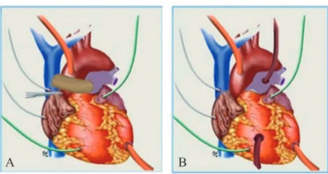 Fig. 1 - Schematic diagram of the surgical preparation. A: Bypass  group B: biventricular group