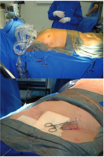 Fig. 1 - Position of the patient, the surgical ield and peripheral  access for ECC. A: panoramic view of the surgical ield, B: 2  cm incision in the left inguinal region for blood exposure and  percutaneous puncture of the right femoral vein