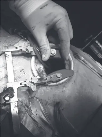 Fig. 1 – Surgical access by lateral minithoracotomy
