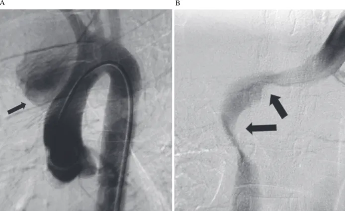 Fig. 1 - Image of arteriography of the ascending aorta and aortic arch (A) and venography of brachiocephalic vein and SVC (B).