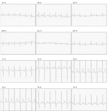 Fig. 1 - Electrocardiogram showed sinus tachycardia, atrial and ventricular overload