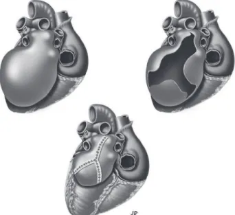 Fig. 5 - Final aspect of the resectionFig. 4 - Atrial tissue resected