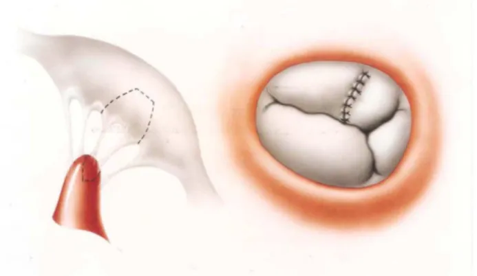 Fig. 6 – Left: a triangular patch is removed from the anterior leaflet of the tricuspid valve, with a satisfactory number and texture of chordae and a wedge of the papillary muscle which is transferred to the mitral valve