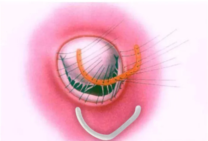 Fig. 12 – Schematic drawing showing the implantation of the Gregori-Braile ring prosthesis