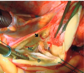Fig. 1 - Photographic documentation of intraoperative showing the apparently normal-looking aortic valve, but with avulsion of the commissure between the left coronary cusp and noncoronary cusp (black arrow)