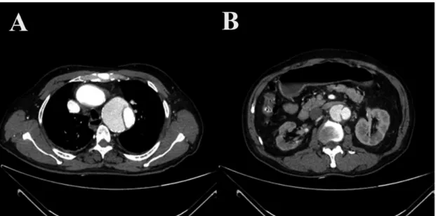Fig. 1 - Computed tomography revealed an aortic dissection with entry and re-entry tears.
