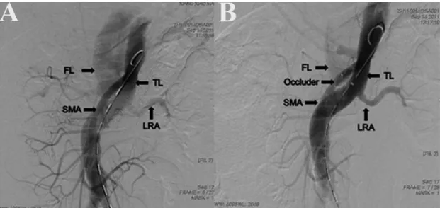 Fig. 3 - Computed tomography (CT) images of the false lumen. A) A large false lumen was identiied in the abdominal  aorta before surgery