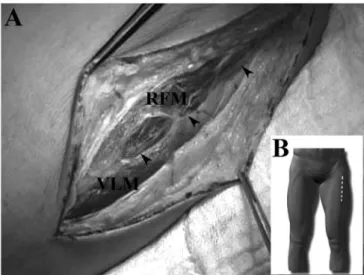Fig. 1 – Approach of the DLFCA. A: Arrowheads point to the  line between the RFM and the VLM where the DLFCA courses  downward through the intermuscular space