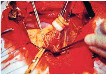 Fig. 1 – Surgical treatment of type A acute dissection of the aorta. 
