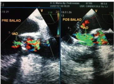 Table 4 shows the valvular diseases treated, STS score for  each patient, and preoperative echocardiographic parameters
