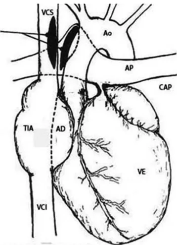Fig. 1 – Atresia tricúspide e transposição das grandes artérias: 