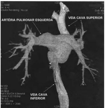 Fig. 3 – Angiotomograia demonstrando ampla anastomose entre a  veia cava superior e o tronco da artéria pulmonar (corte seccional),  medindo 30,5 x 30,8 mm, sem sinais de trombose