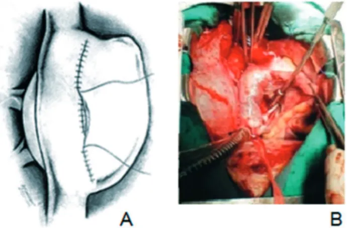 Fig. 2 - A: Suture of an anterior atrial patch on the IC-SC tunnel. 