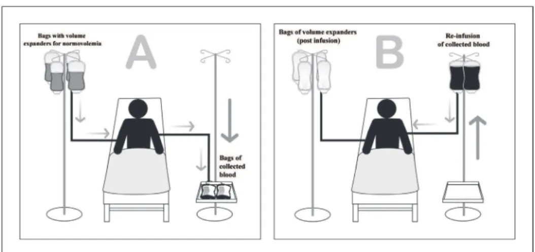 Fig. 4 - Schematic representation of intraoperative blood recovery. The collected blood is mixed  with anticoagulant, iltered, washed, concentrated and returned to the patient