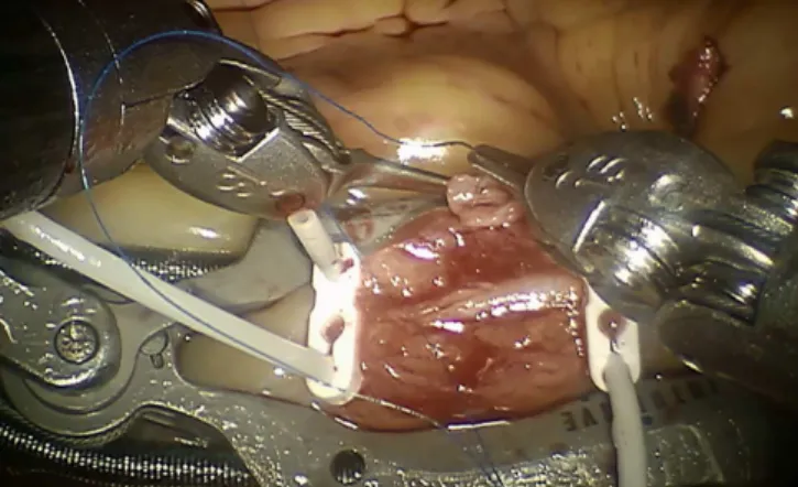 Fig. 2 - First stitch in the mammary artery.