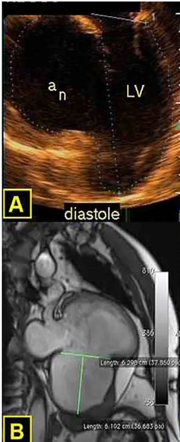 Fig. 1 – A) Preoperative transesophageal echocardiography.