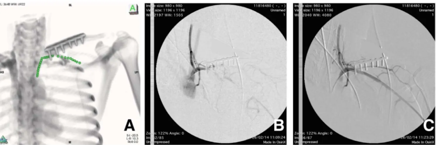 Fig. 2 - A) Three-dimensional-by-volume image rotation avoiding the overlap of the osteosynthesis upon the tomographic point marks