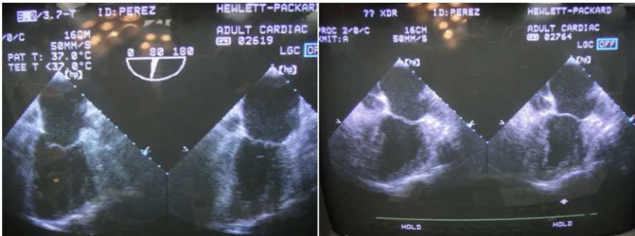 Fig. 5 -  Transesophageal echo performed before (left) and after (right) the anastomosis in the same patient  conditions: anesthetic drugs, use of inotropics and balloon assistance.