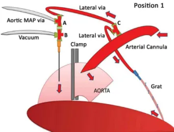 Fig. 1 - We propose a standard of two basic positions, which begin  after the clamping is performed once proximally to the insertion of the  arterial cannula in the ascending aorta for perfusion and reperfusion  of the aortic root