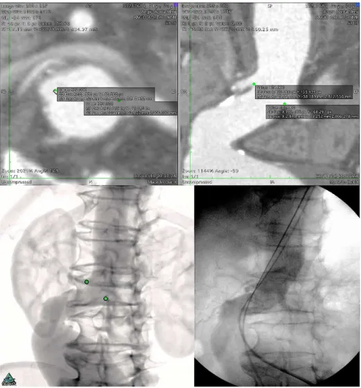 Fig. 1 - Up - ostial renal artery markings in axial projection, with auxiliary view on longitudinal  section (at right).
