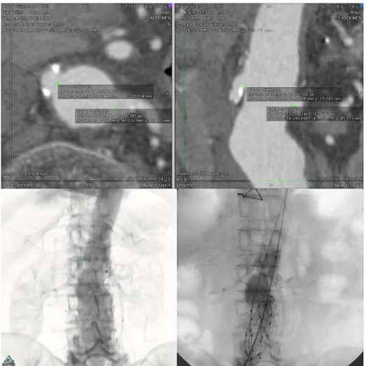 Fig. 2 - Up - ostial renal artery markings in axial projection, with auxiliary view on longitudinal  section (at right).
