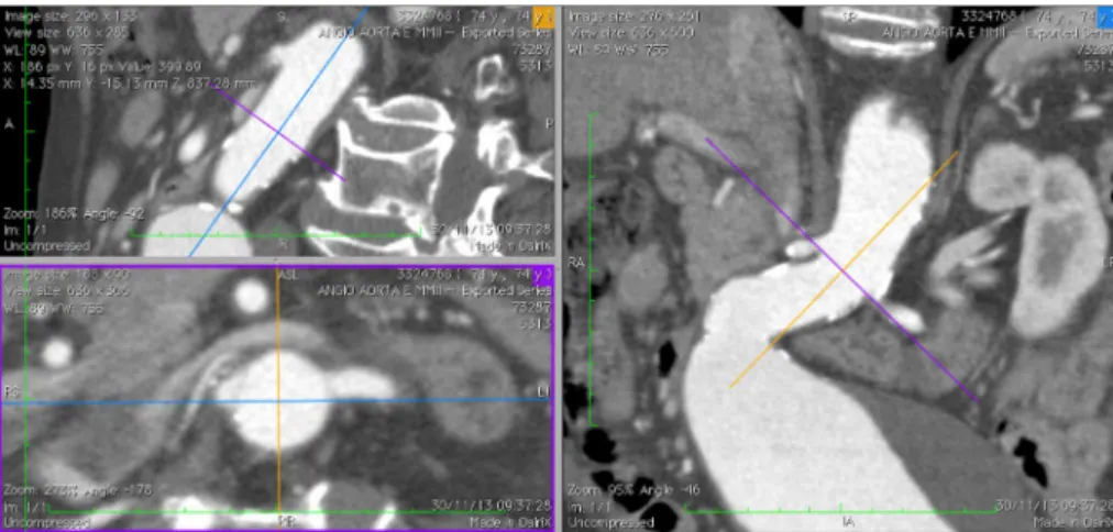 Fig. 1 - Multiplanar reconstruction (MPR), with repair of sagittal and coronal  projections and axial cut at right angles (below left)