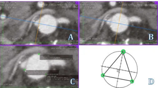 Fig. 2 - Above: - Tangent drawn from the projection of the right renal artery. B - Intraluminal positioning  for beginning of space marking