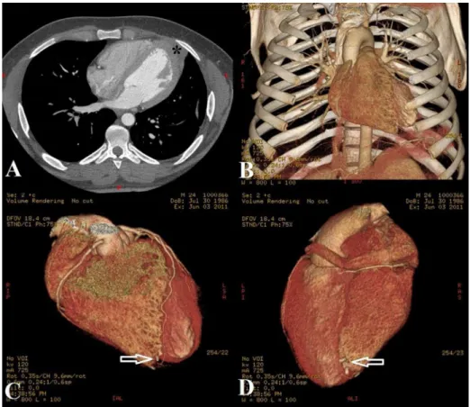 Fig. 2 – A: Possible ibrous formation in the site of wound repair is seen (asterisk). B: Three- Three-dimensional view of the chest and heart