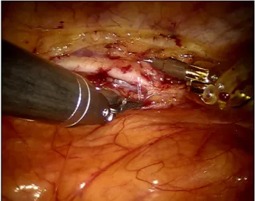 Fig. 1 – Harvesting of the left internal thoracic artery with ine  forceps and spatula
