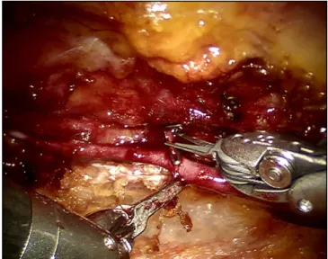 Fig. 3 – Use of endoscopic Potts scissors to cut branch