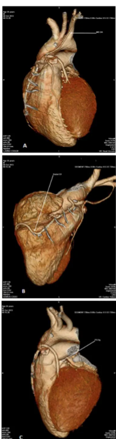 Fig. 1 – Angiotomograia das coronárias. A: Enxerto pérvio da artéria  mamária interna esquerda para descendente anterior