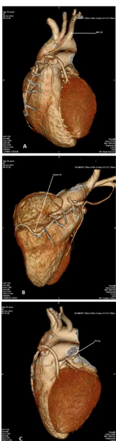 Fig. 1 - Coronary CT angiography. 