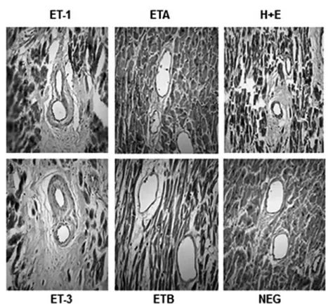 Fig. 2 - Immunostaining of sections of stenotic valve from a patient with rheumatic fever