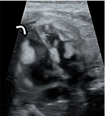 Fig. 1 - Two-dimensional echocardiographic at 22 weeks of gestation  in the “four-chamber” view showing a rhabdomyoma in the internal  wall of fetal left ventricle (white arrow).